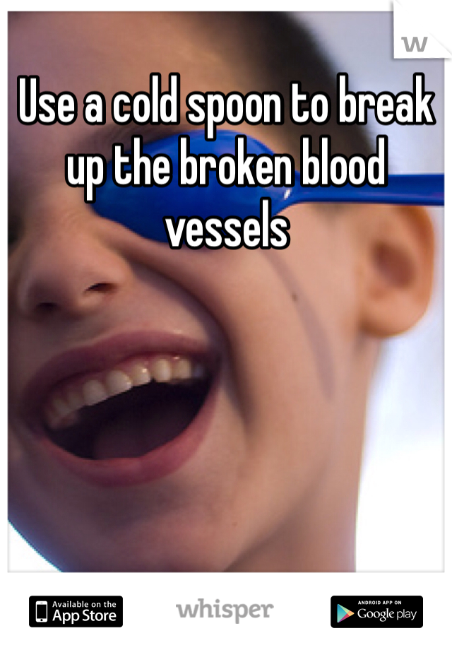 Use a cold spoon to break up the broken blood vessels 