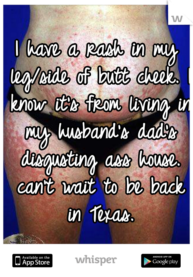 I have a rash in my leg/side of butt cheek. I know it's from living in my husband's dad's disgusting ass house. can't wait to be back in Texas.