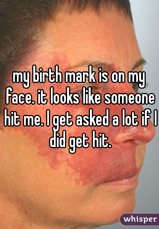 my birth mark is on my face. it looks like someone hit me. I get asked a lot if I did get hit.