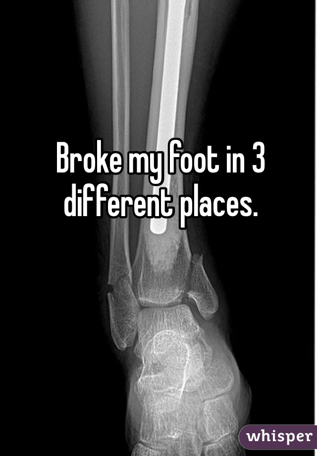 Broke my foot in 3 different places. 