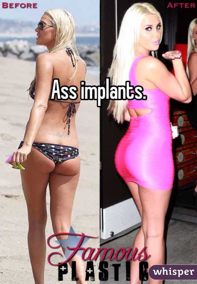 Ass implants.