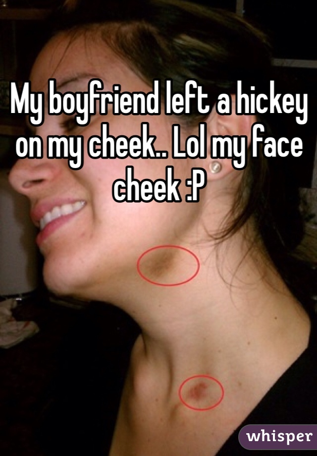 My boyfriend left a hickey on my cheek.. Lol my face cheek :P