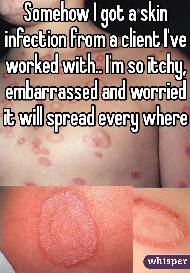 Somehow I got a skin infection from a client I've worked with.. I'm so itchy, embarrassed and worried it will spread every where