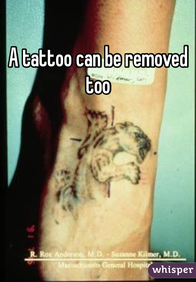 A tattoo can be removed too