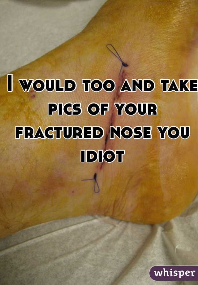 I would too and take pics of your fractured nose you idiot 