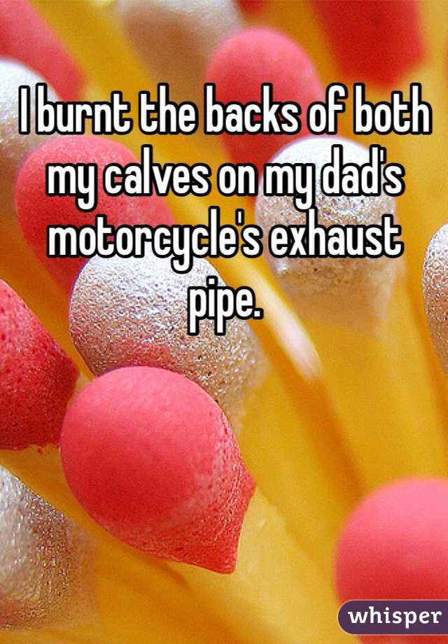 I burnt the backs of both my calves on my dad's motorcycle's exhaust pipe.