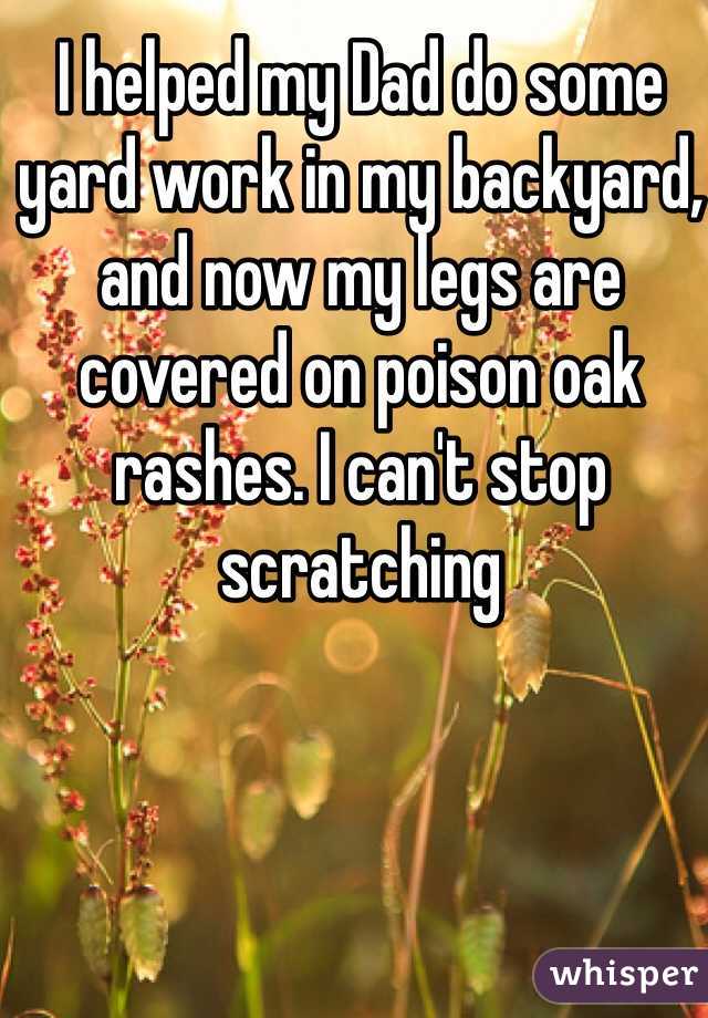 I helped my Dad do some yard work in my backyard, and now my legs are covered on poison oak rashes. I can't stop scratching 