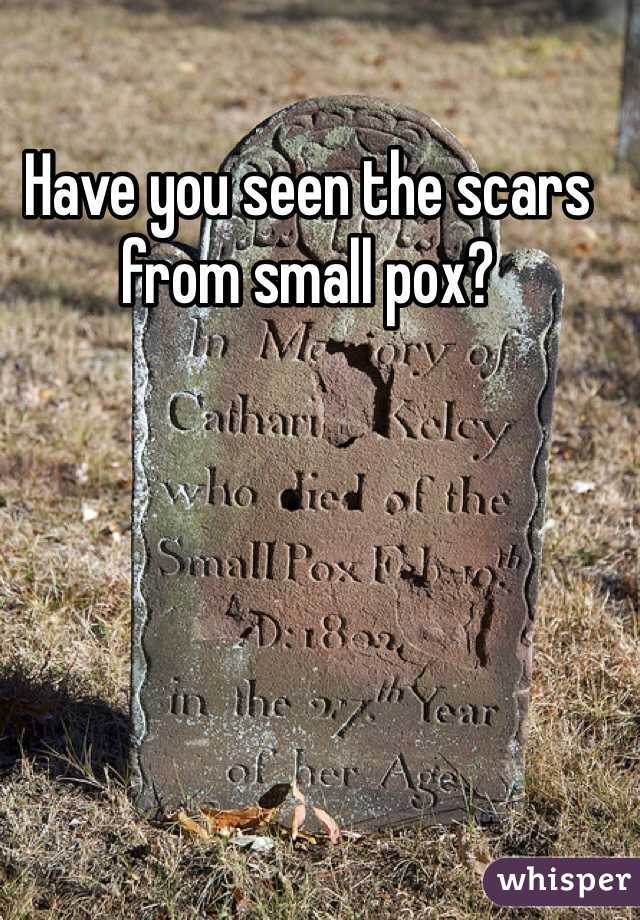 Have you seen the scars from small pox?