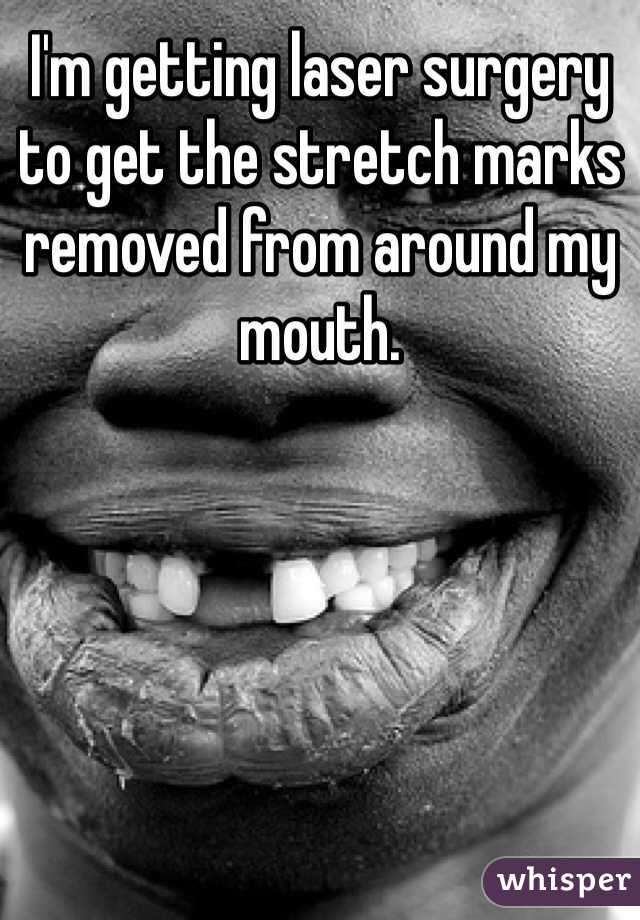 I'm getting laser surgery to get the stretch marks removed from around my mouth. 