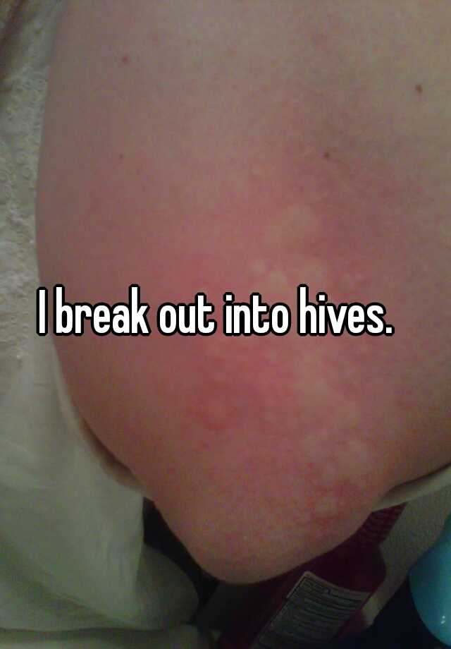 i-break-out-into-hives