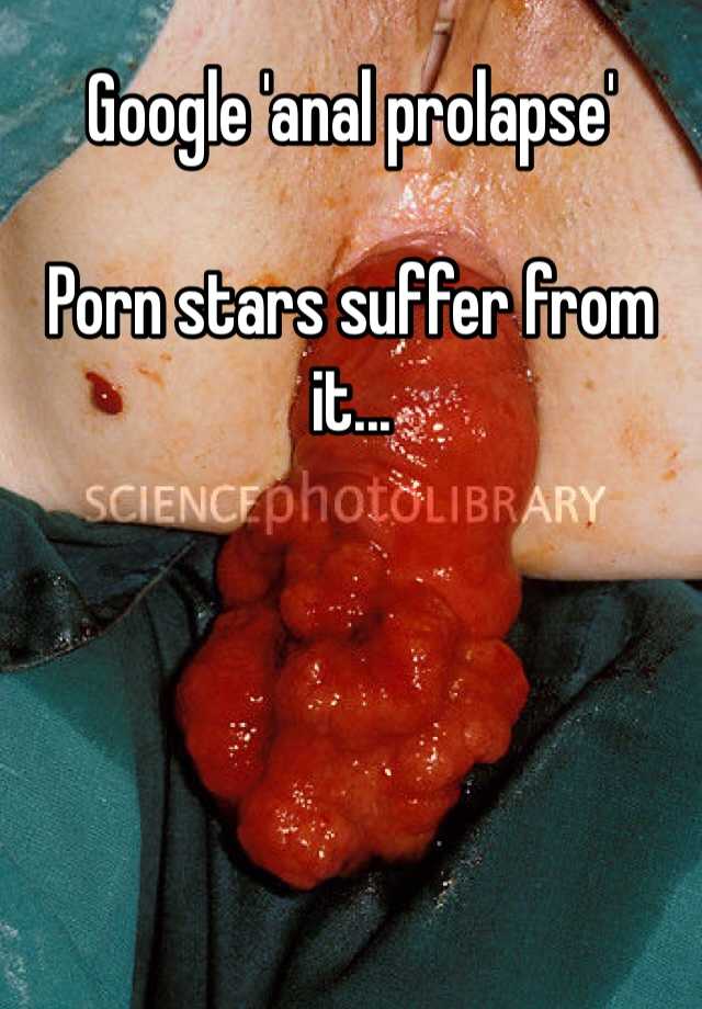 Stars Porn Anal Prolapse - Google 'anal prolapse' Porn stars suffer from it...