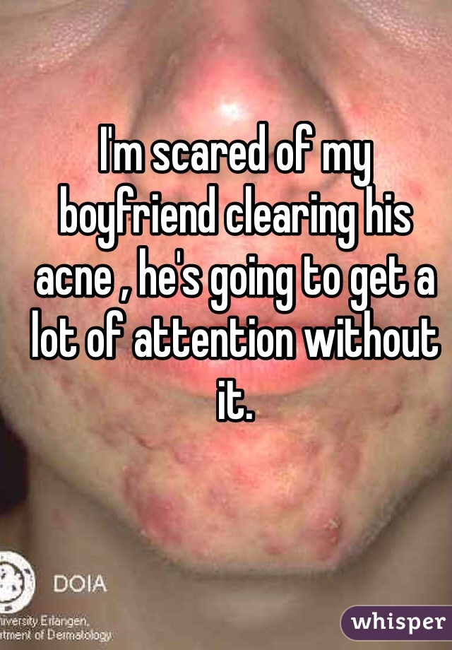 I'm scared of my boyfriend clearing his acne , he's going to get a lot of attention without it. 