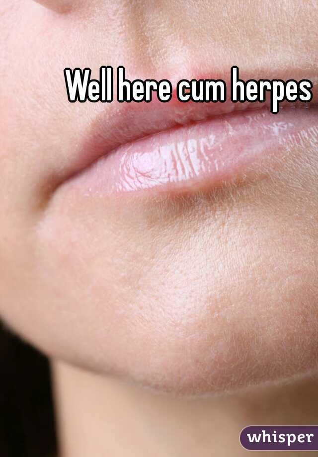 Well here cum herpes