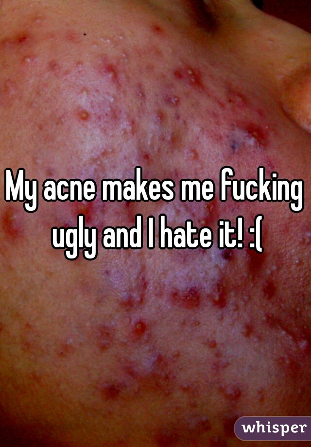 My acne makes me fucking ugly and I hate it! :(