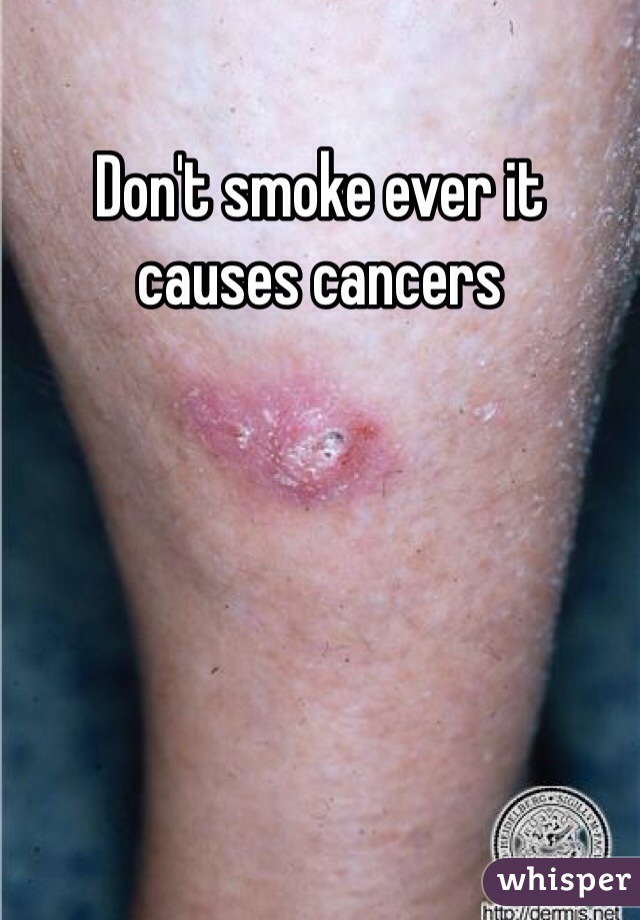 Don't smoke ever it causes cancers