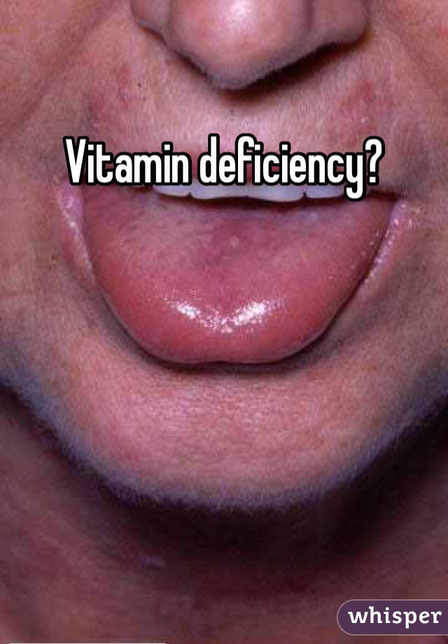 Vitamin deficiency?