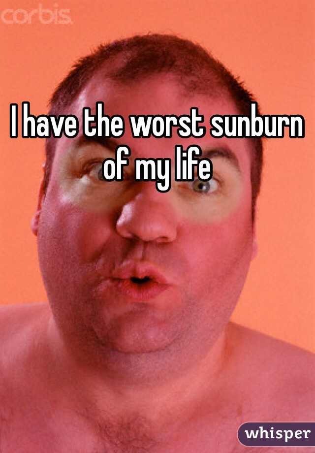 I have the worst sunburn of my life