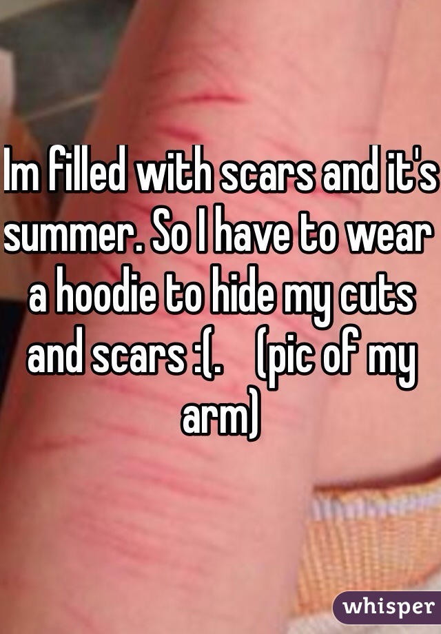 Im filled with scars and it's summer. So I have to wear a hoodie to hide my cuts and scars :(.    (pic of my arm) 