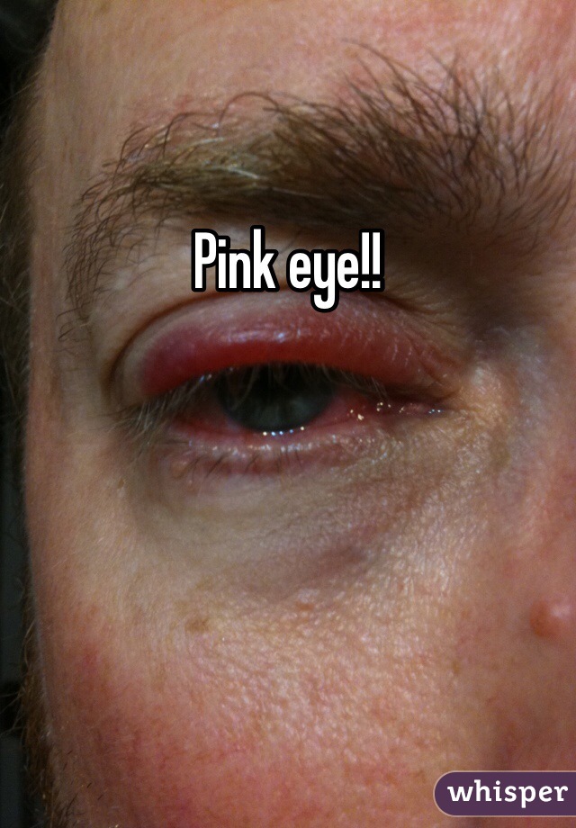 Pink eye!!