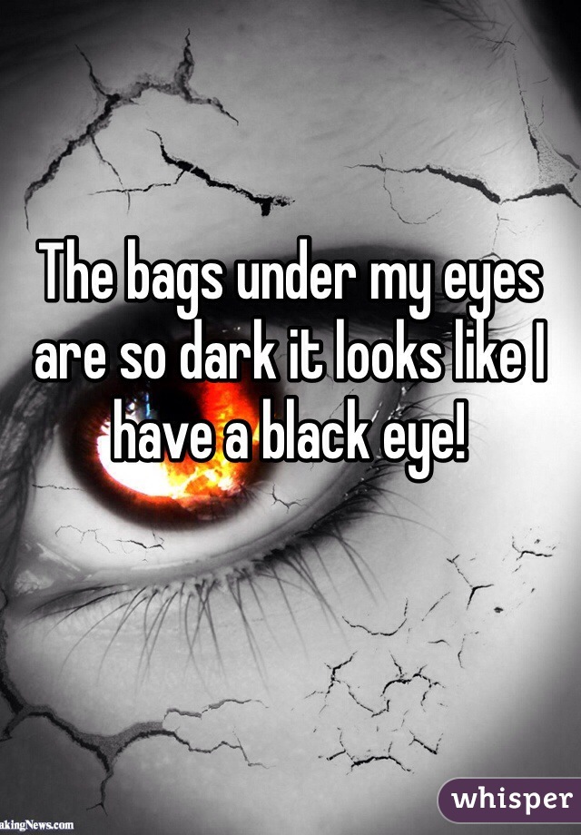 The bags under my eyes are so dark it looks like I have a black eye! 
