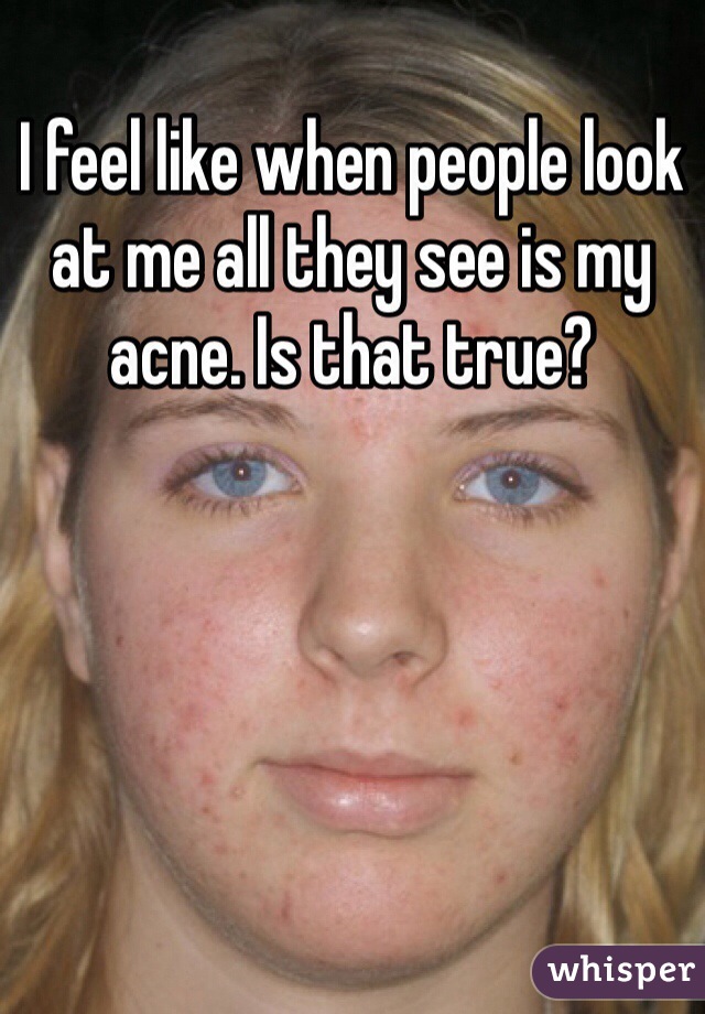 I feel like when people look at me all they see is my acne. Is that true? 