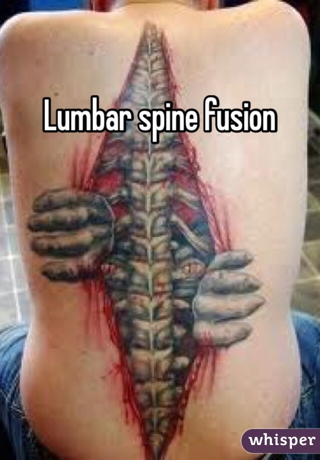 Lumbar spine fusion