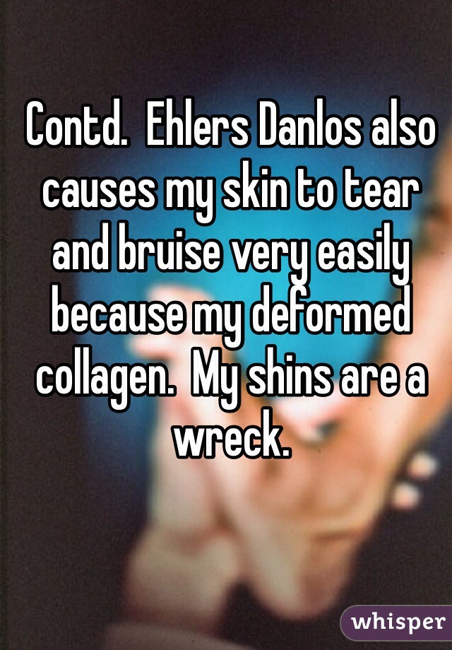 Contd.  Ehlers Danlos also causes my skin to tear and bruise very easily because my deformed collagen.  My shins are a wreck. 