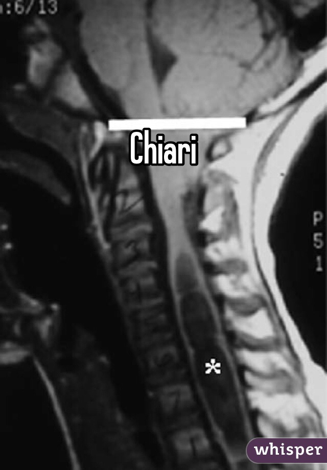 Chiari 