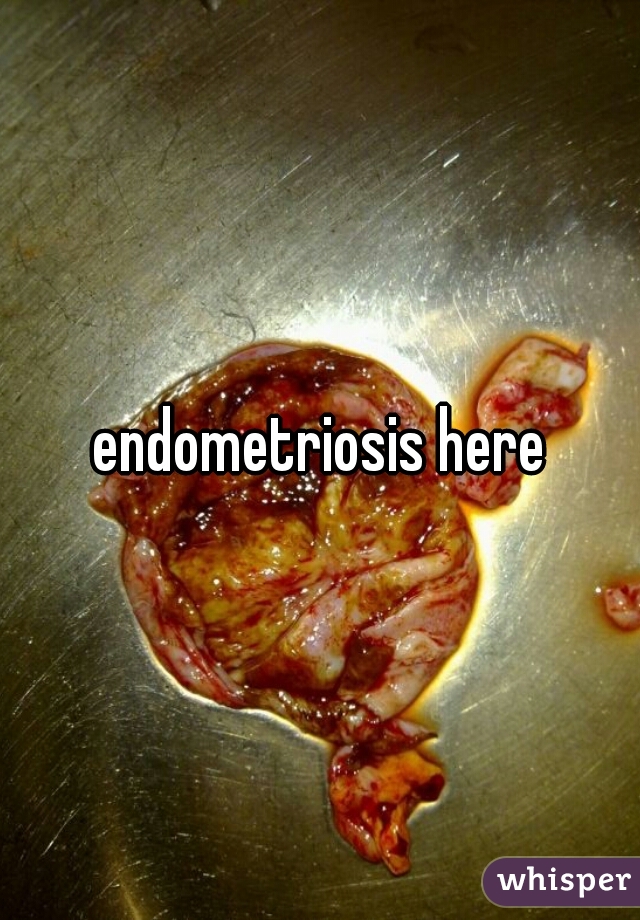 endometriosis here