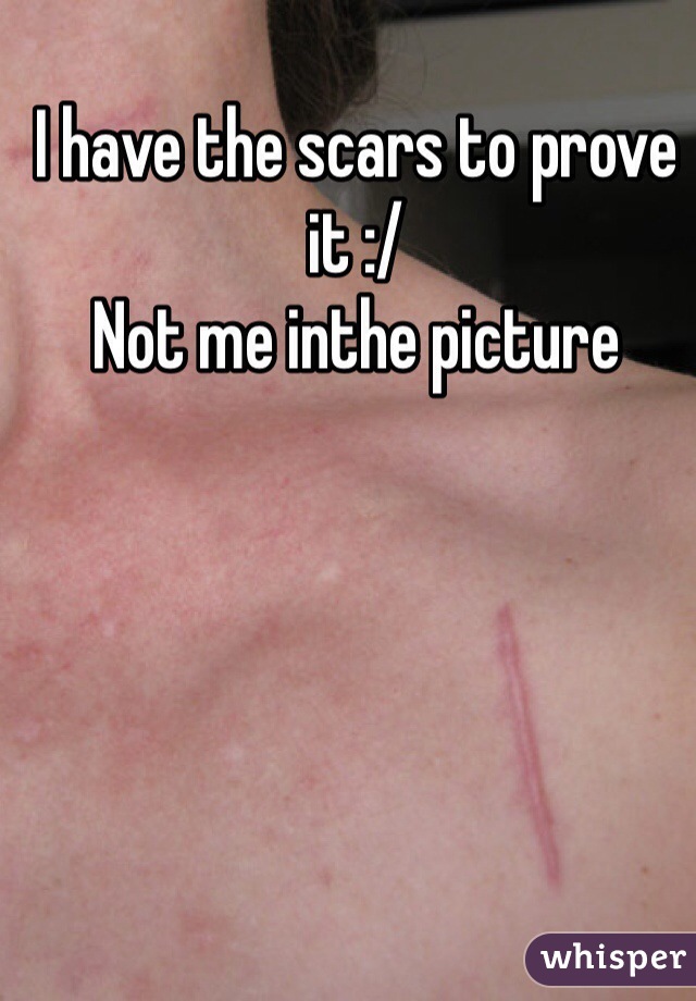 I have the scars to prove it :/
Not me inthe picture
