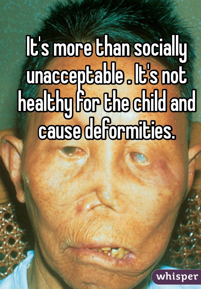 It's more than socially unacceptable . It's not healthy for the child and cause deformities.