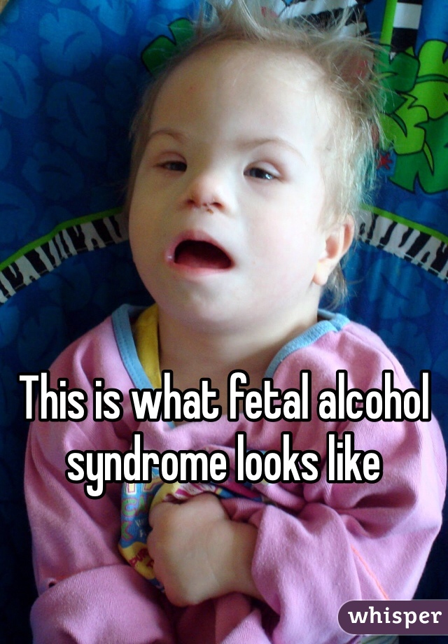 





This is what fetal alcohol syndrome looks like 