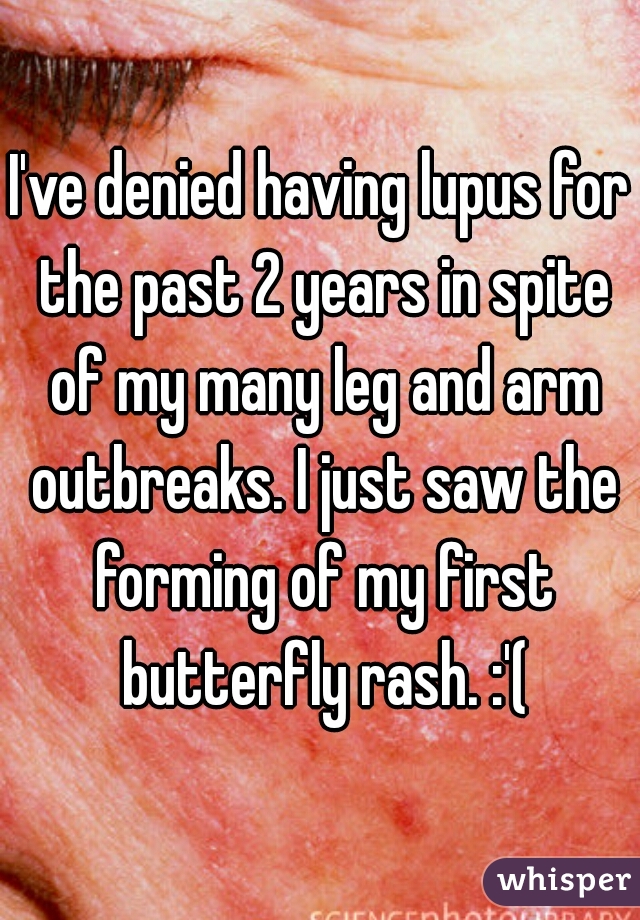 I've denied having lupus for the past 2 years in spite of my many leg and arm outbreaks. I just saw the forming of my first butterfly rash. :'(
