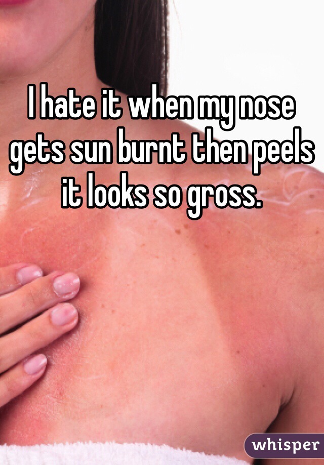 I hate it when my nose gets sun burnt then peels it looks so gross.