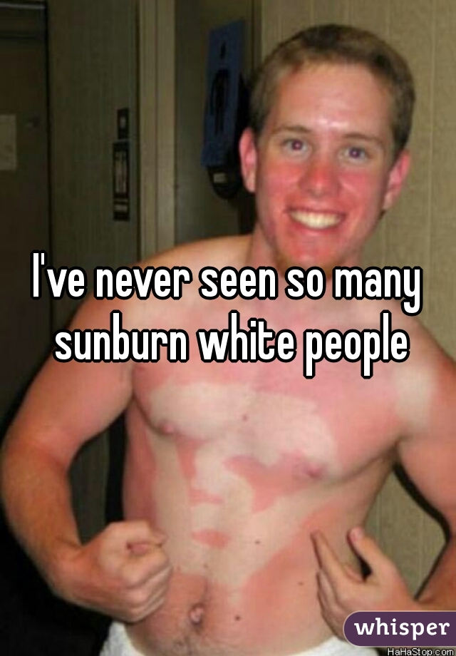 I've never seen so many sunburn white people