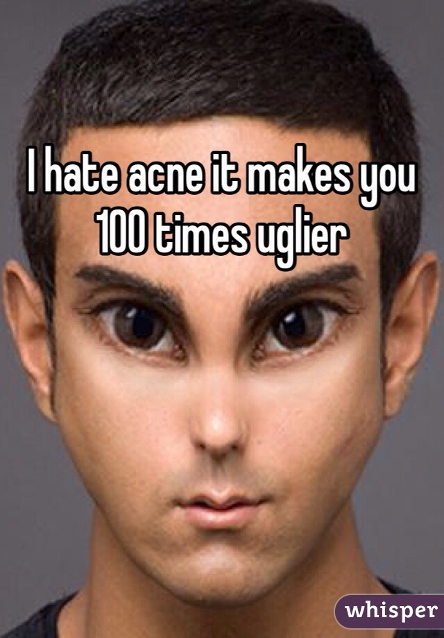 I hate acne it makes you 100 times uglier