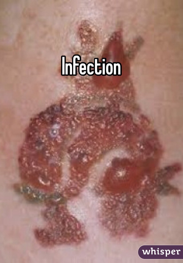 Infection