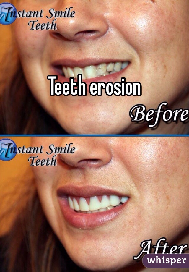Teeth erosion 
