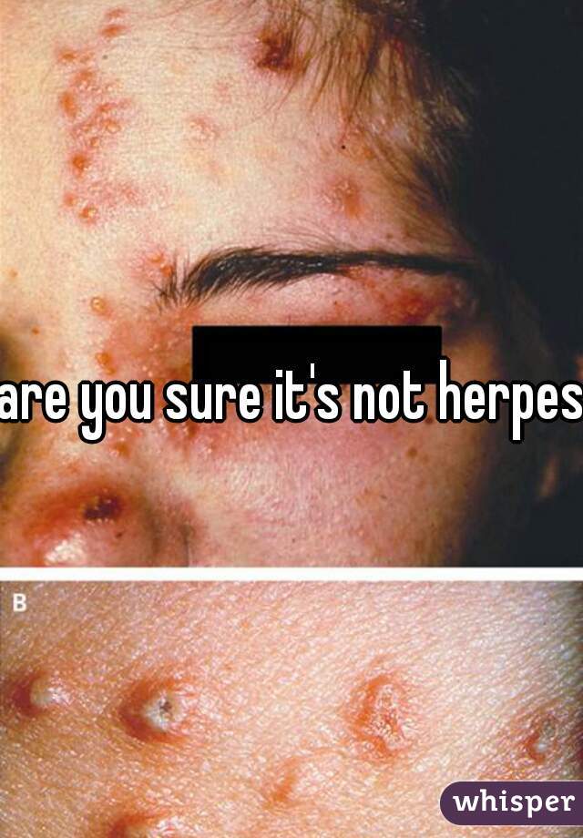 are you sure it's not herpes