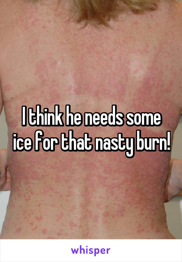 I think he needs some ice for that nasty burn!