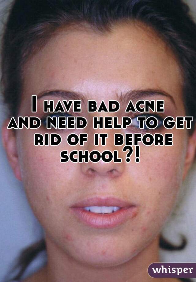 I have bad acne 
and need help to get rid of it before school?! 