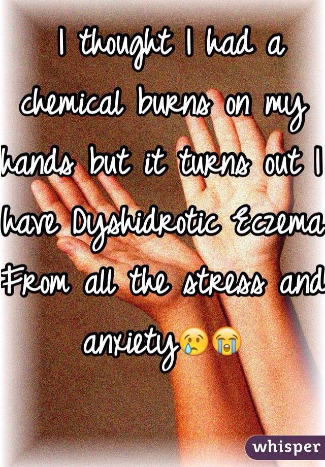  I thought I had a chemical burns on my hands but it turns out I have Dyshidrotic Eczema
From all the stress and anxiety😢😭 