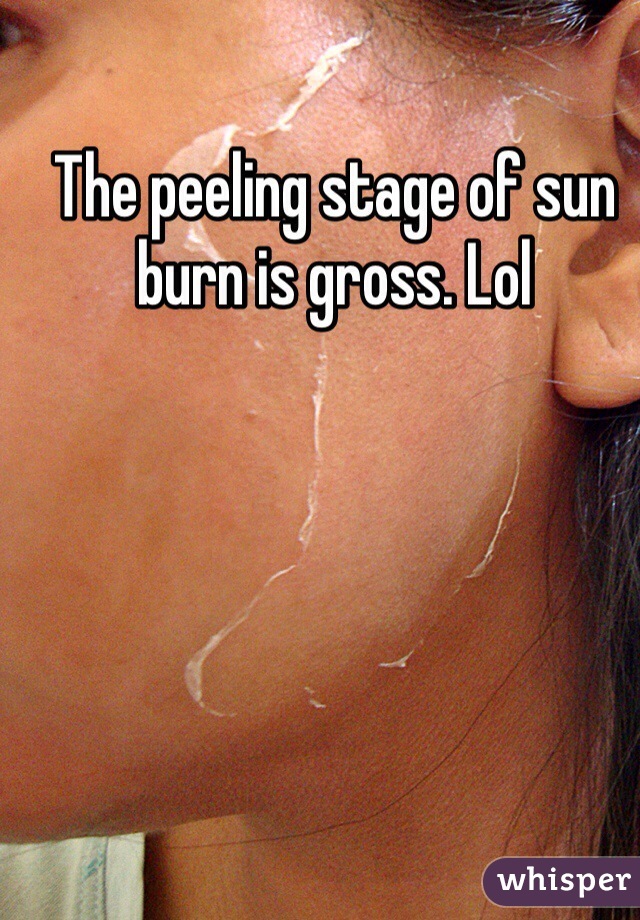 The peeling stage of sun burn is gross. Lol 