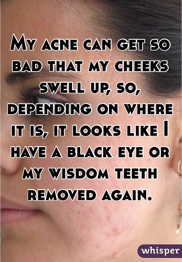 My acne can get so bad that my cheeks swell up, so, depending on where it is, it looks like I have a black eye or my wisdom teeth removed again.