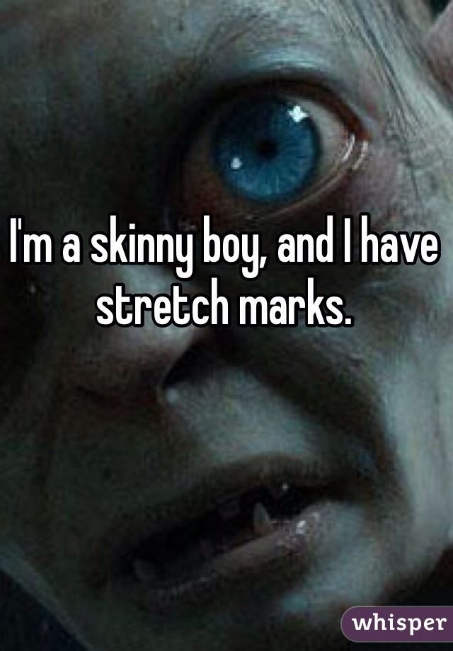 I'm a skinny boy, and I have stretch marks. 