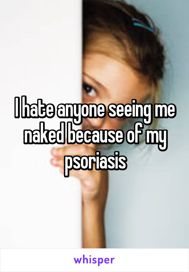 I hate anyone seeing me naked because of my psoriasis