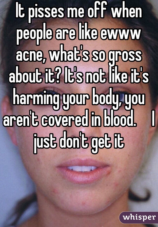 It pisses me off when people are like ewww acne, what's so gross about it? It's not like it's harming your body, you aren't covered in blood.     I just don't get it