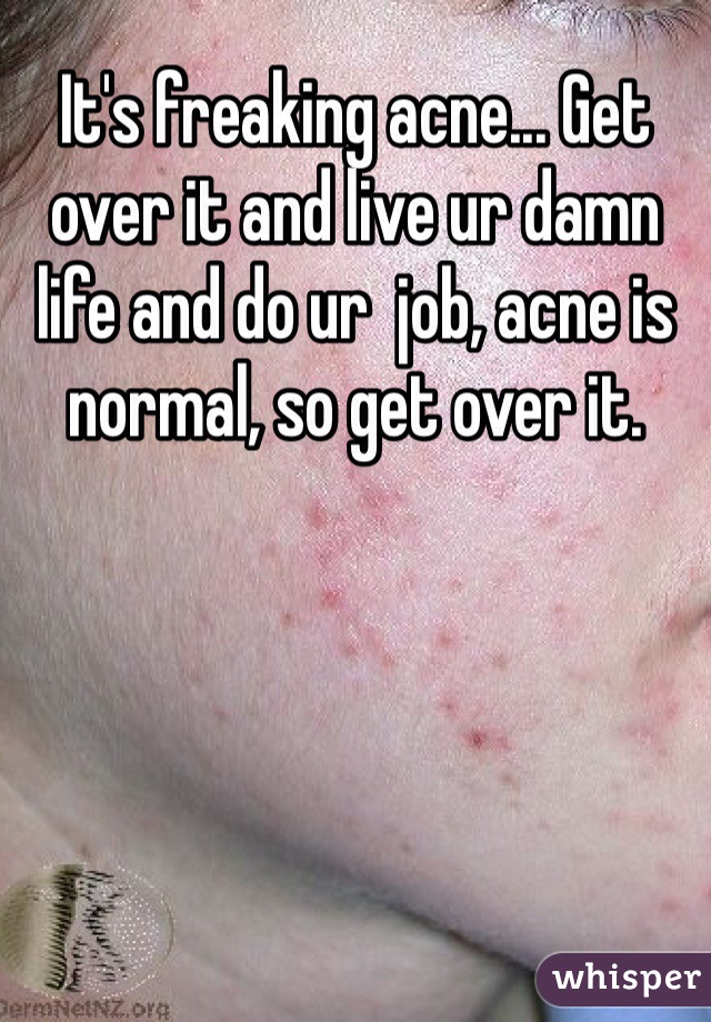 It's freaking acne... Get over it and live ur damn life and do ur  job, acne is normal, so get over it.