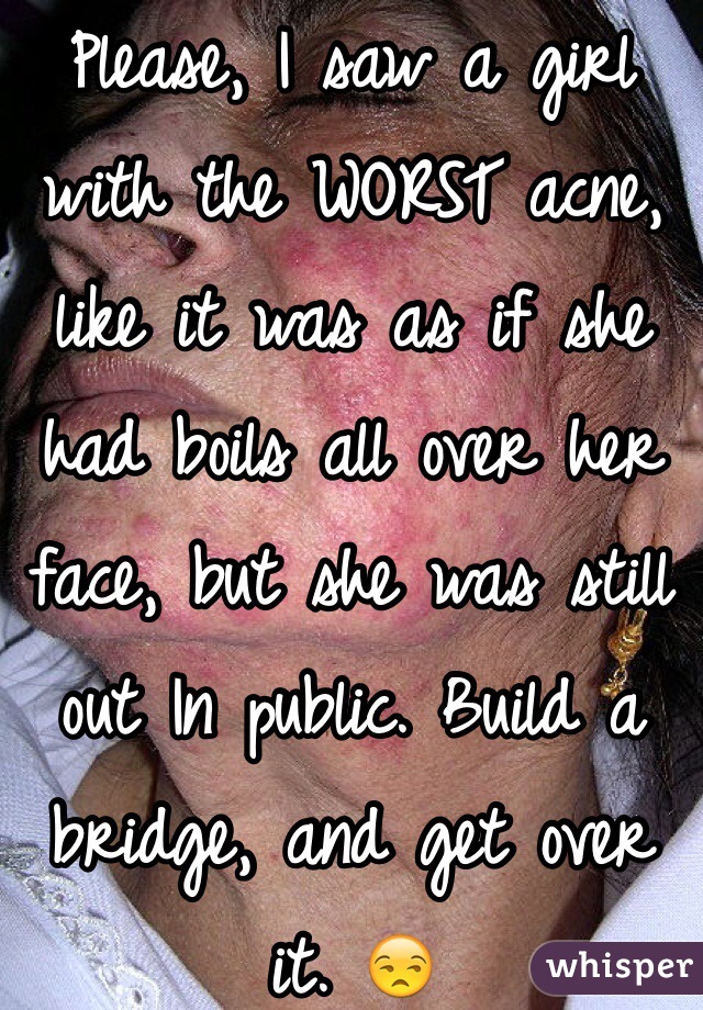 Please, I saw a girl with the WORST acne, like it was as if she had boils all over her face, but she was still out In public. Build a bridge, and get over it. 😒
