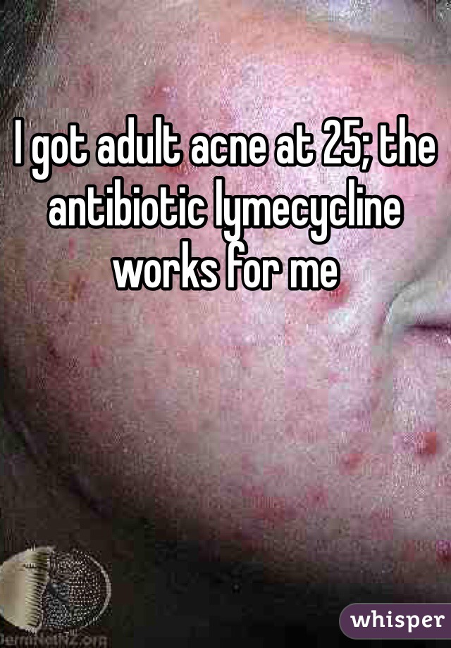 I got adult acne at 25; the antibiotic lymecycline works for me